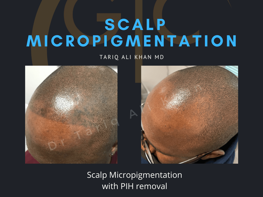 Gentle Care Laser Tustin & Long Beach Before and After picture - Scalp micropigmentation